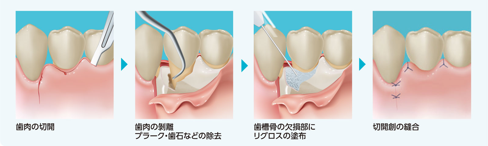 フラップ手術（歯肉剝離掻爬手術）における歯周組織再生剤の塗布